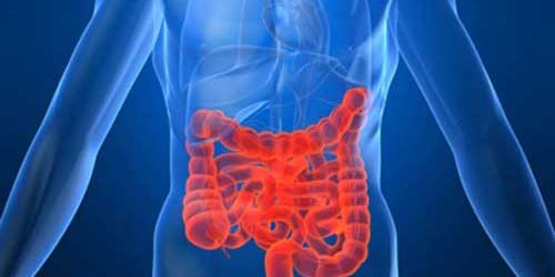 Crohn's disease- chronic inflammation of the digestive tract