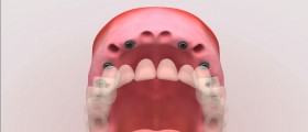Risks Associated With Dental Implant Surgery