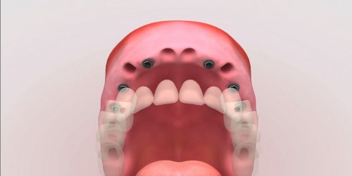 Missing Permanent Teeth? Why It Happens and What To Do about It