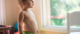 How to Treat Severe Diaper Rash At Home
