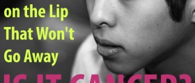 Dry Patch on the Lip That Won't Go Away: Is It Lip Cancer?