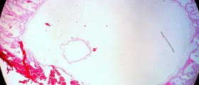 Ectopic Pregnancy: Beyond The Fallopian Tubes