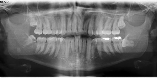 lump under jaw, swollen tongue, sore teeth, pain up side of face ...