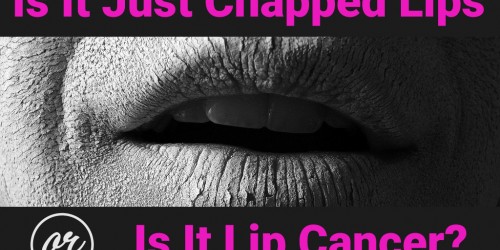 Is It Just Chapped Lips or Is It Lip Cancer (Actinic Cheilitis)?