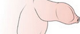 Phimosis Treatment