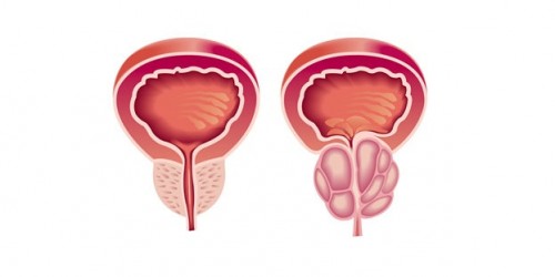 Why Men Sometimes Choose Not To Get Prostate Cancer Treatment