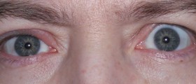 How To Treat A Stye At Home