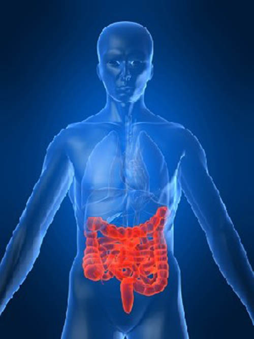 Crohn's disease- chronic inflammation of the digestive tract