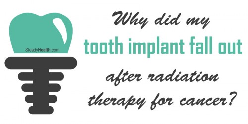 Why Did My Tooth Implant Fall Out After Radiation Therapy For Cancer?
