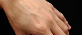 Causes and Treatment of Ganglion Cysts