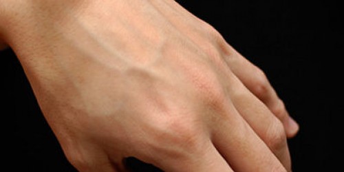 Causes and Treatment of Ganglion Cysts