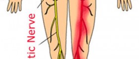 Treatment For Sciatic Nerve Pain