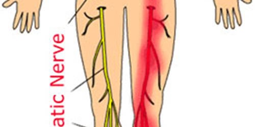 Treatment For Sciatic Nerve Pain