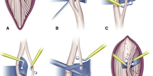 A Brief Guide To Cervical Rhizotomy