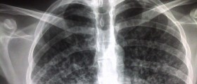 Extremely Drug-Resistant Tuberculosis Threatens Western Health Care System
