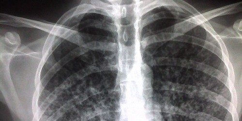 Extremely Drug-Resistant Tuberculosis Threatens Western Health Care System