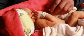 Male Varicocele And Infertility: Myths And Reality