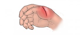 The Five Signs Of Wound Infection