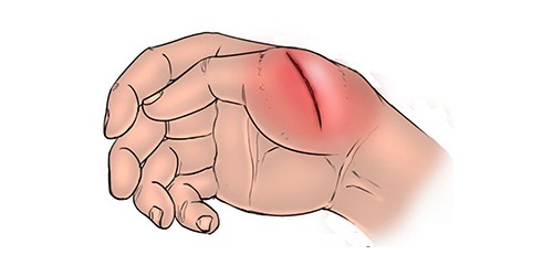 The Five Signs Of Wound Infection