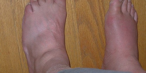 Gout: Causes And Prevention