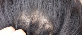 Get Rid Of Dandruff Once And For All