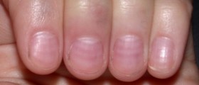 Healthy Nails: A Window To Your Overall Health