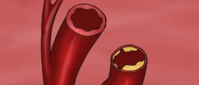 "Good" And "Bad" Cholesterol: Not As Simple As It Sounds