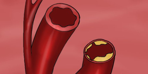 "Good" And "Bad" Cholesterol: Not As Simple As It Sounds