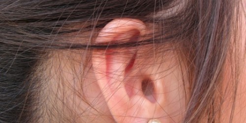 Stapedectomy for Otosclerosis