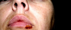 Cold Sores (Herpes Simplex Virus): Causes, Prevention, Symptoms And Treatment