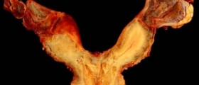 What is a bicornuate uterus?