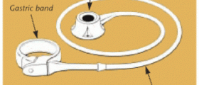 How much could i expect to pay for lap band surgery?