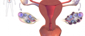 What PCOS patients need to know about weight loss and pregnancy