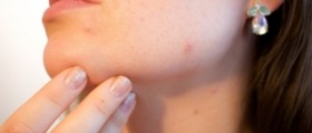How to get rid of acne and the emotional problems it causes