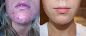 How to get rid of acne fast