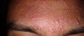 Acne vulgaris what is it and how is it different than regular acne?
