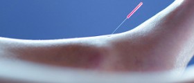 Acupuncture for cold sores