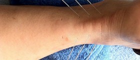 Therapy for tendonitis