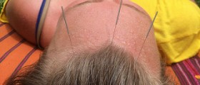 Acupuncture does not work for labor pain?