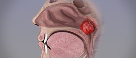 Adenoids in adults review