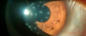 About chronic keratitis