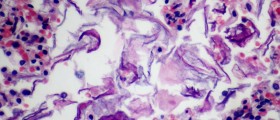 Problems with amniotic fluid