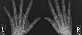 Chronic juvenile arthritis