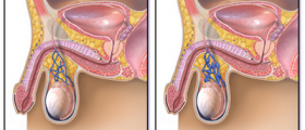 Varicocele and Male Infertility