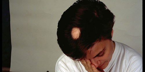 Medical Causes Of Hair Loss In Women