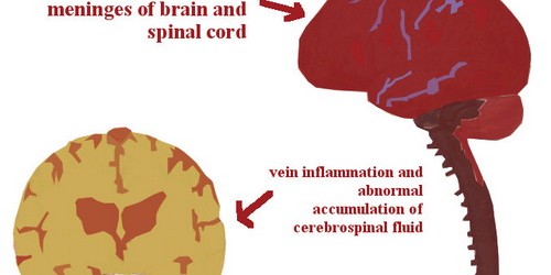 Brain-Eating Amoeba Due To Stagnant Water, CDC Says