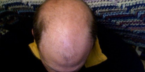 The Most Common Hair Disorders