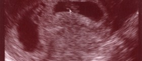 Selective Reduction For Multifetal Pregnancies: What You Need To Know