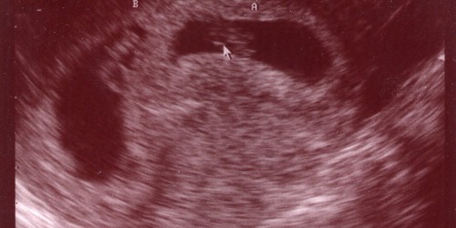 Selective Reduction For Multifetal Pregnancies: What You Need To Know