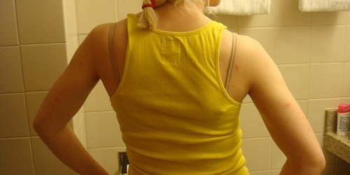 Remedies for Insect Bites